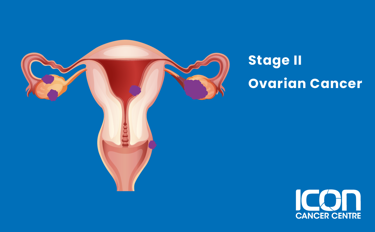 Stage II ovarian cancer illustration