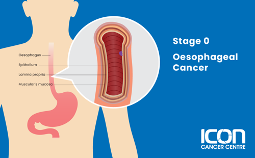 Stage 0 oesophageal cancer illustration