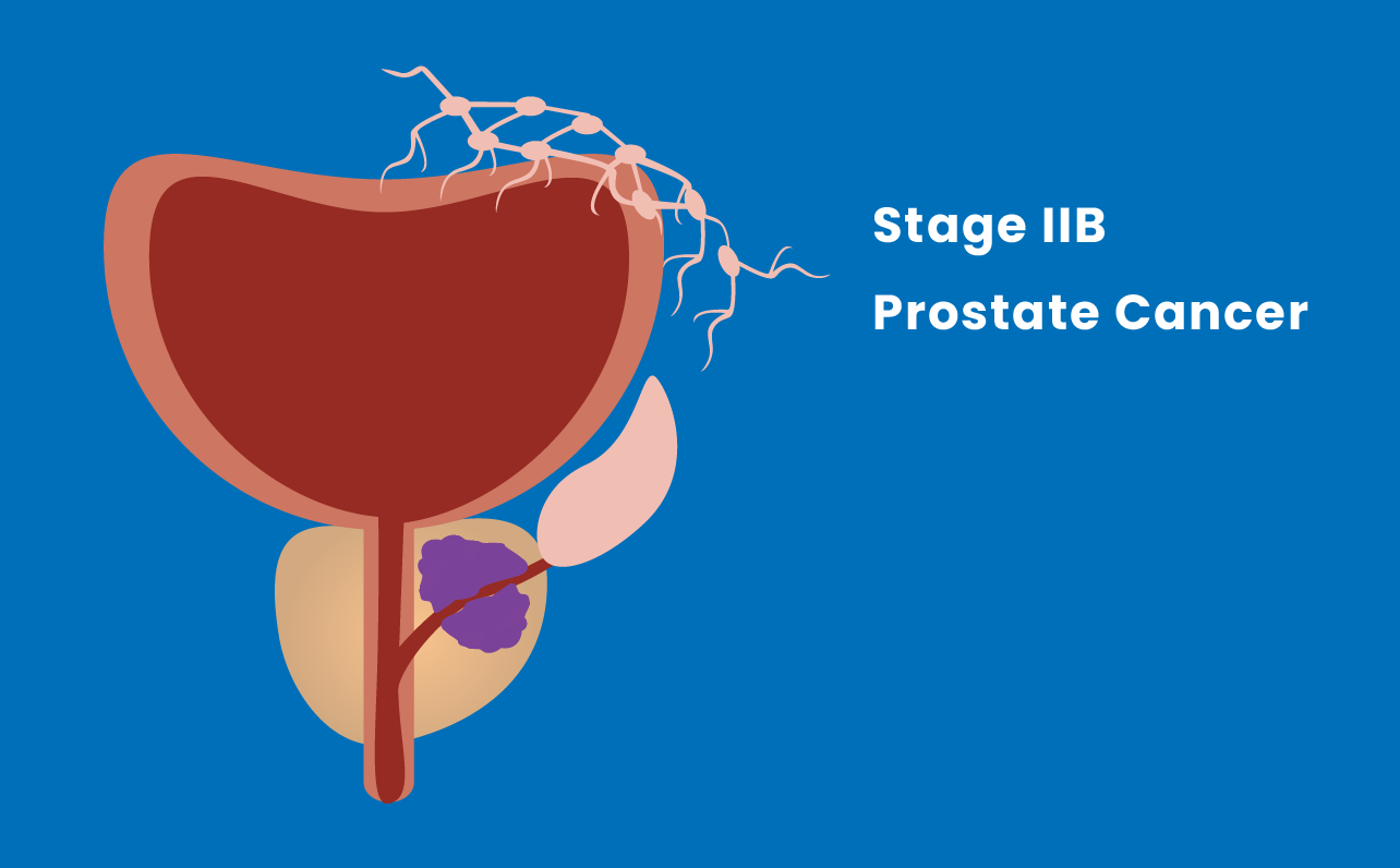 Stage IIB prostate cancer illustration