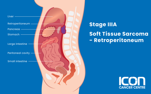 Stage IIIA soft tissue sarcoma in retroperitoneum illustration
