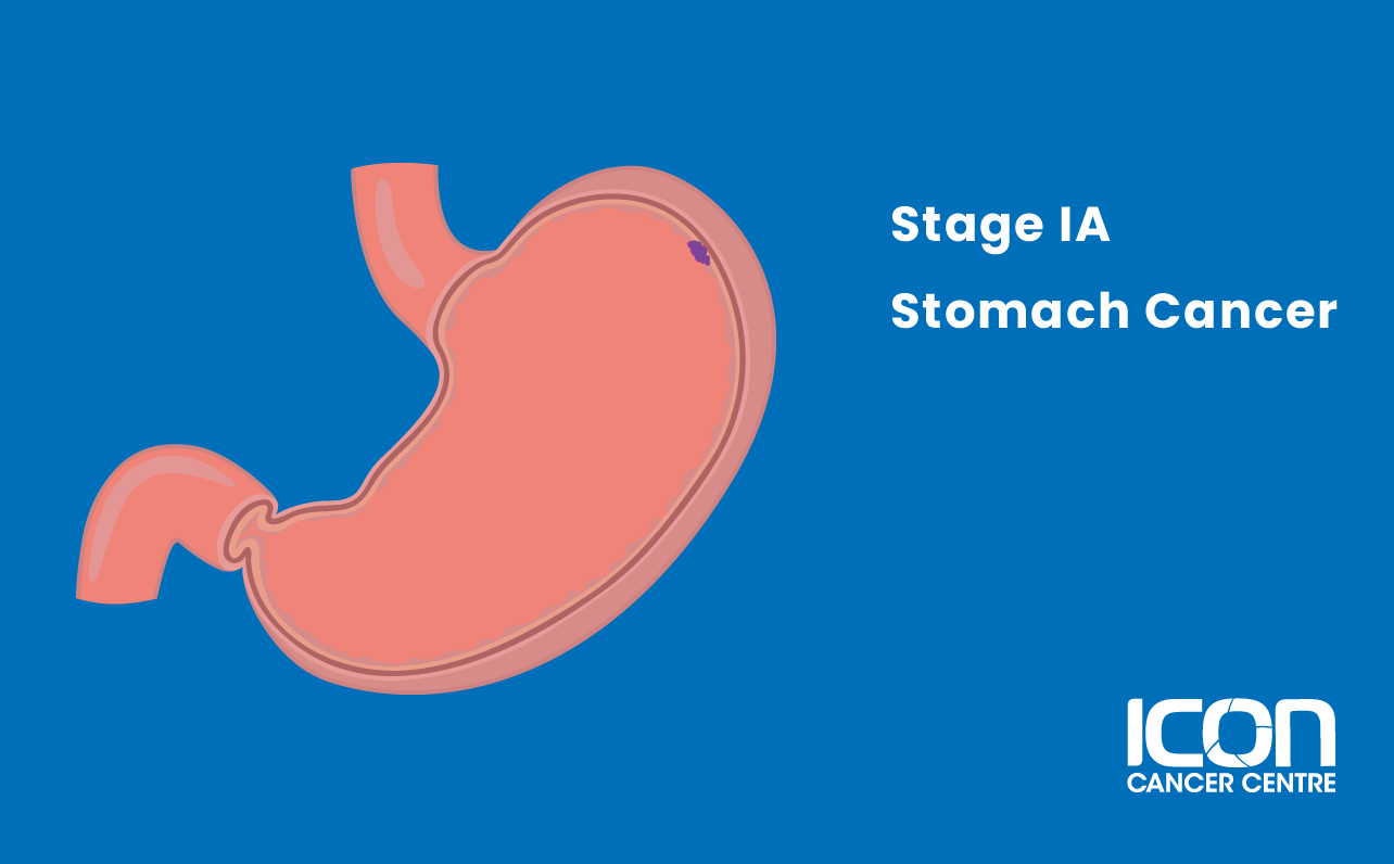 Stage IA stomach cancer illustration