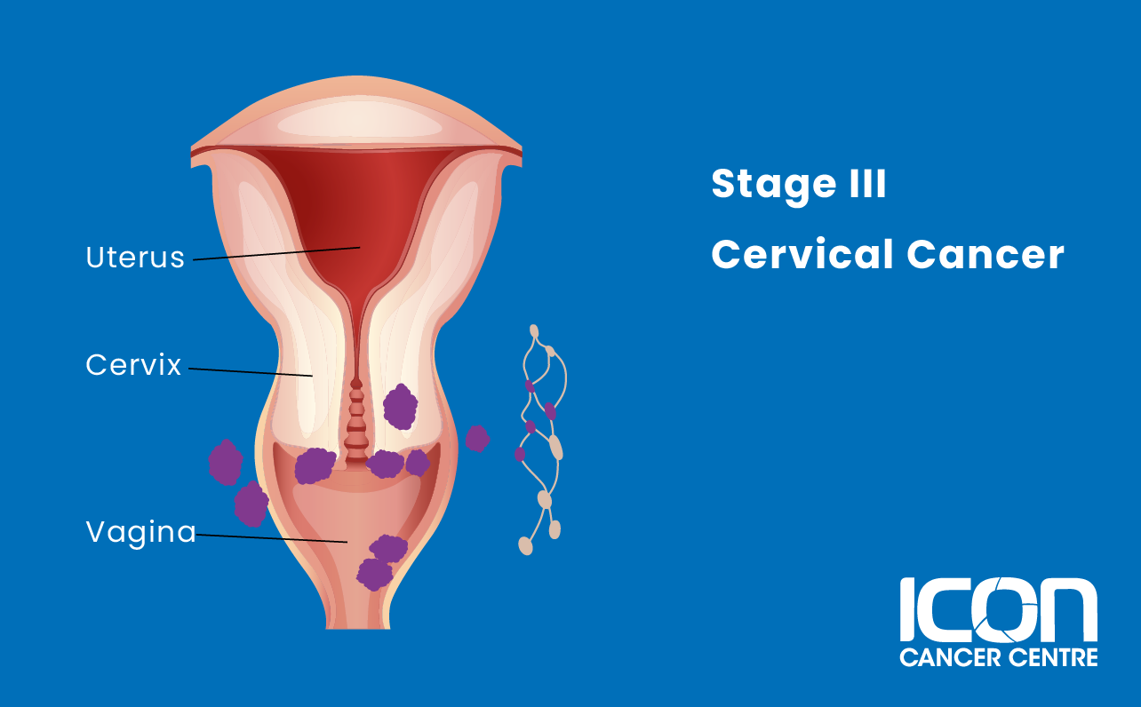Stage III cervical cancer illustration