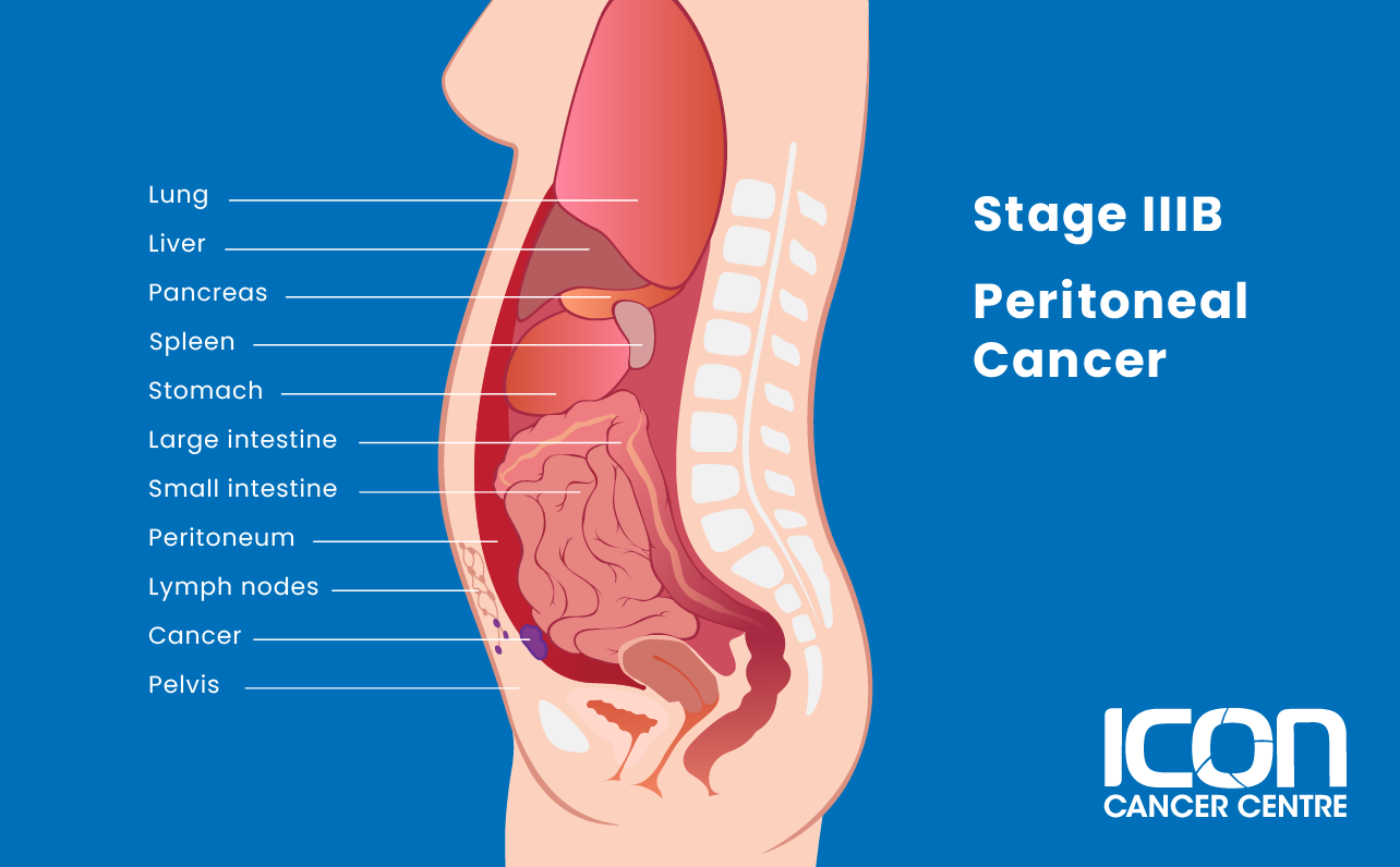 Stage IIIB peritoneal cancer illustration