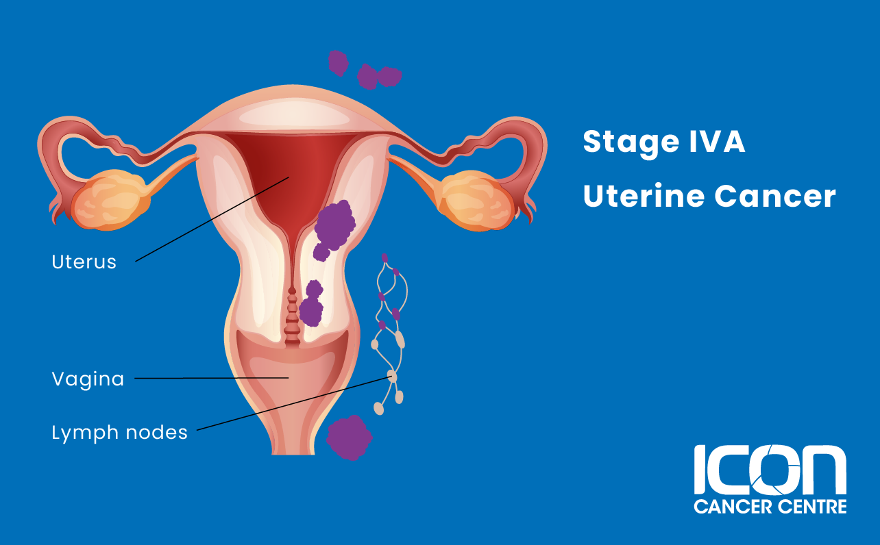 Stage IVA uterine cancer illustration