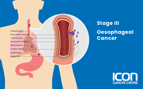 Stage III oesophageal cancer illustration