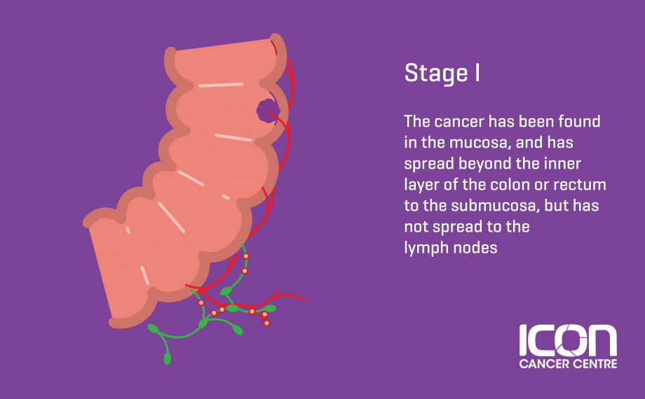 What Is Bowel Cancer Bowel Cancer Explained — Icon Cancer Centre