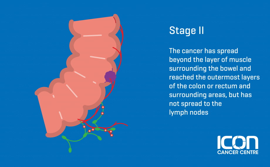 What Is Bowel Cancer Bowel Cancer Explained Icon Cancer Centre