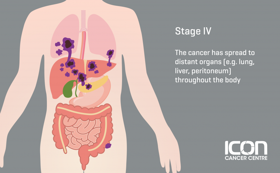 what-is-bowel-cancer-bowel-cancer-explained-icon-cancer-centre