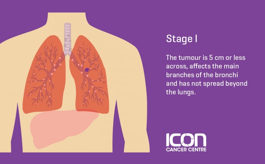 Can you be cured of stage 4 lung cancer