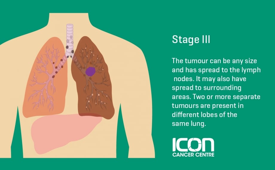 What is Lung Cancer? Lung Cancer Explained — Icon Cancer