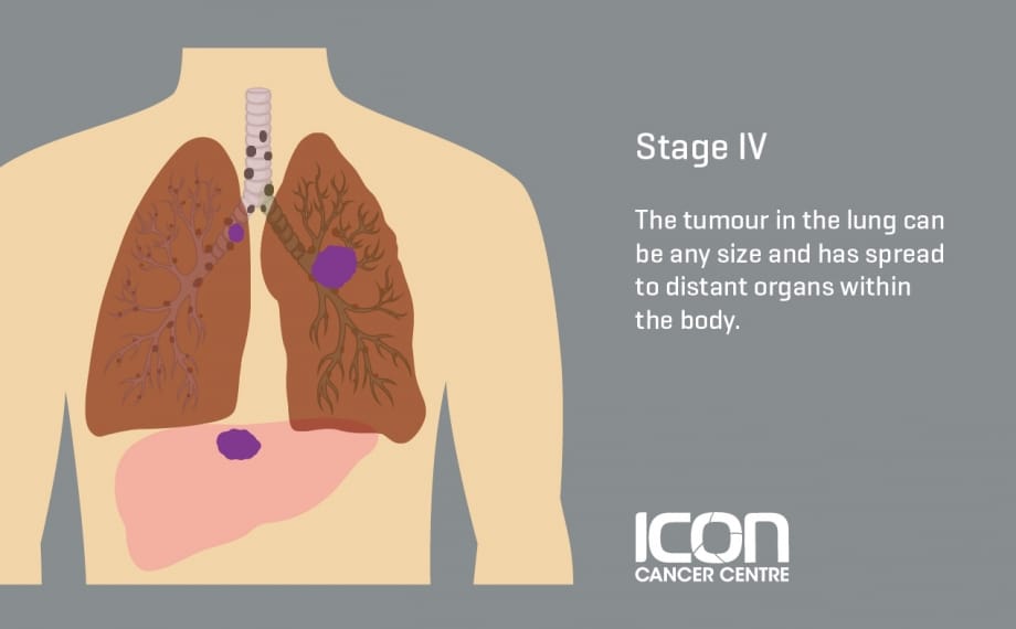 What Is Lung Cancer Lung Cancer Explained — Icon Cancer Centre