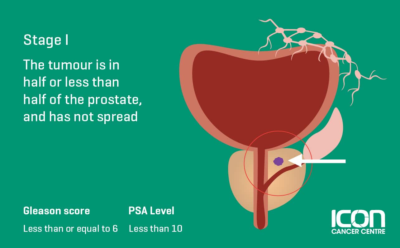 What Is Prostate Cancer Prostate Cancer Explained Icon Cancer Centre 4741