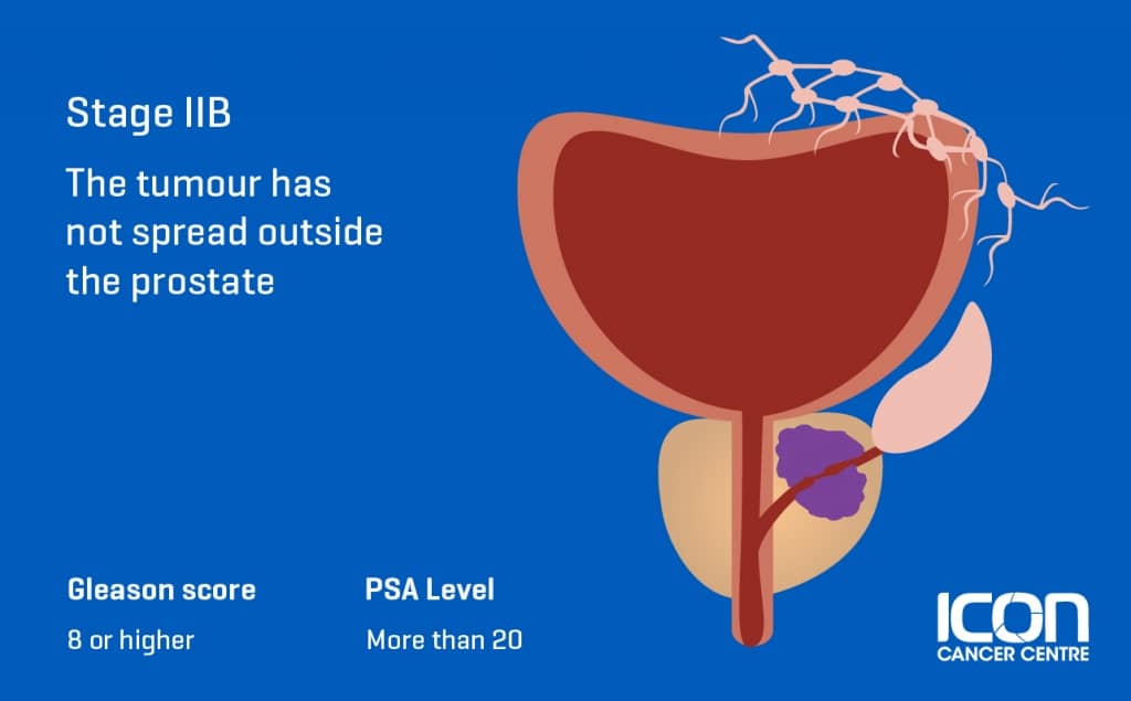 What Is Prostate Cancer Prostate Cancer Explained Icon Cancer Centre