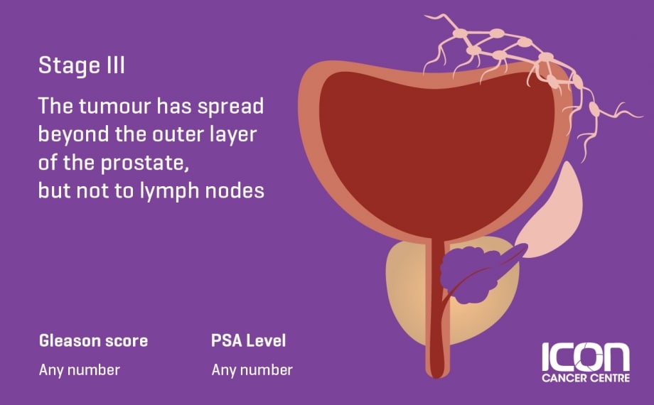 what-is-prostate-cancer-prostate-cancer-explained-icon-cancer-centre