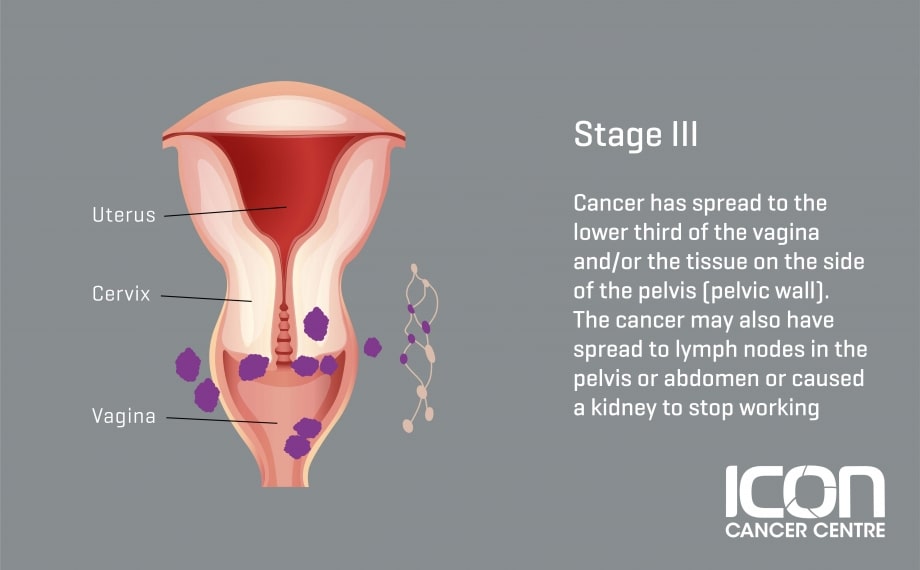 What is Cervical Cancer? Cervical Cancer Explained — Icon ...