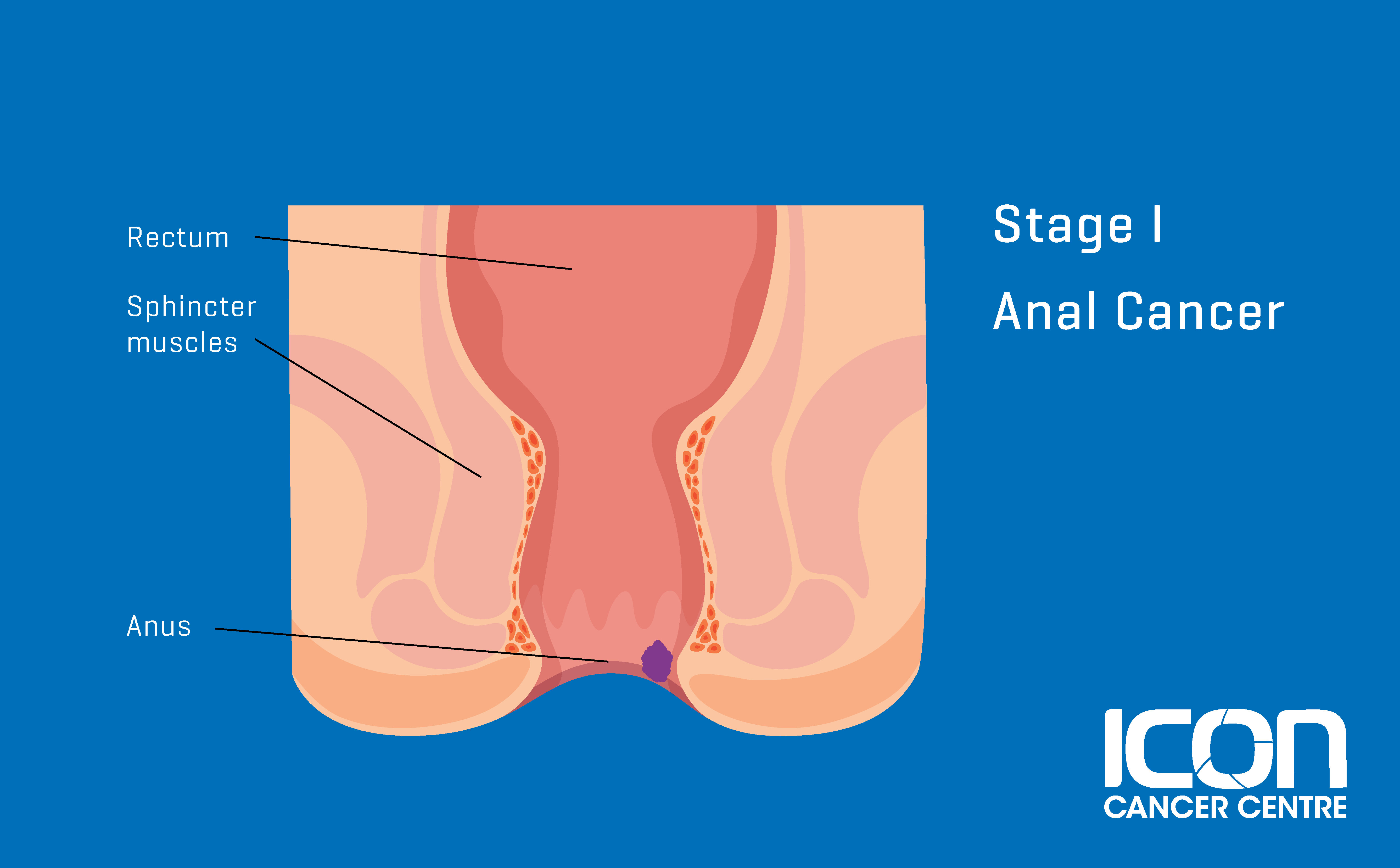 What is Anal Cancer? Anal Cancer Explained | Icon Cancer Centre