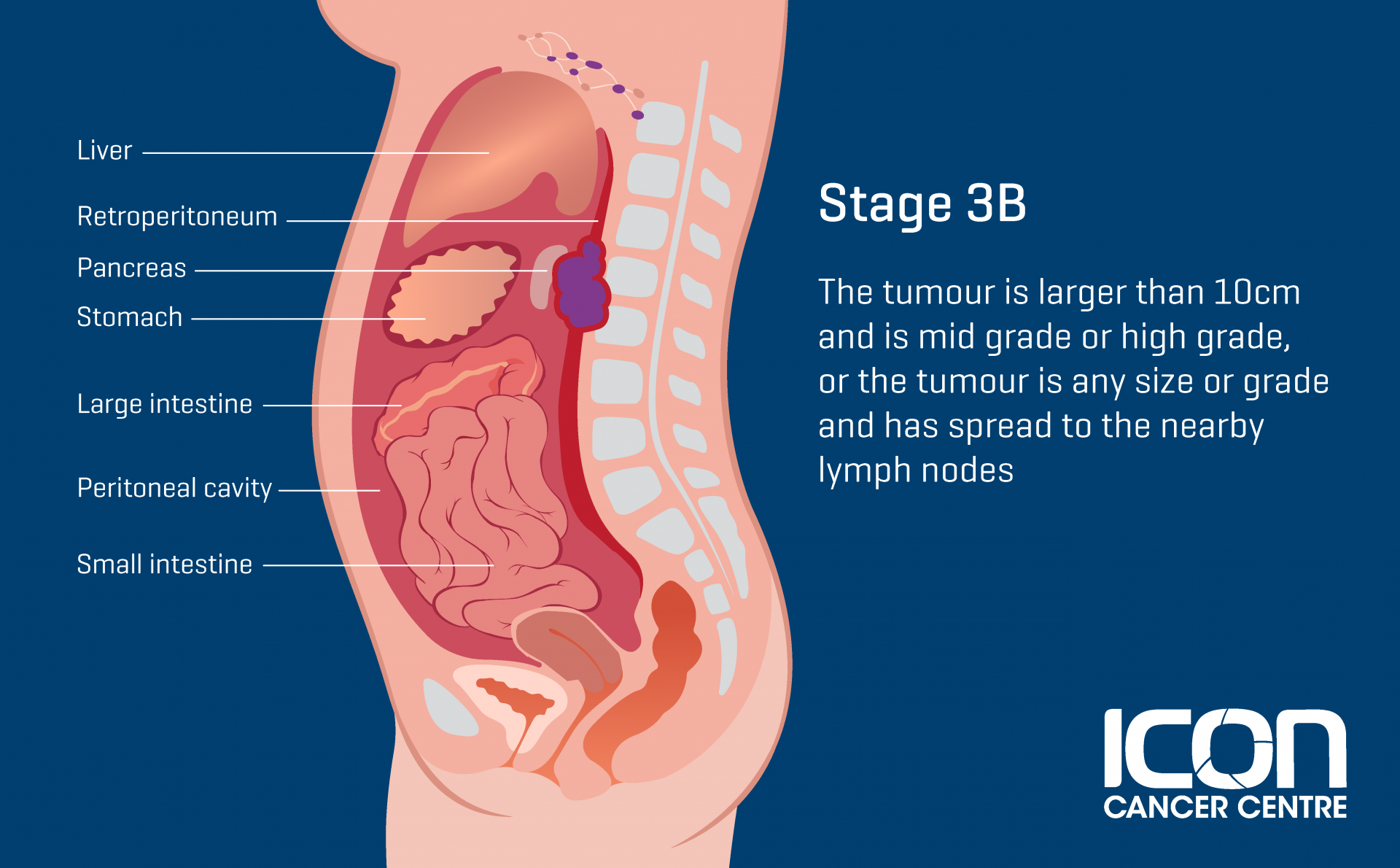 what-is-soft-tissue-sarcoma-soft-tissue-sarcoma-explained-icon