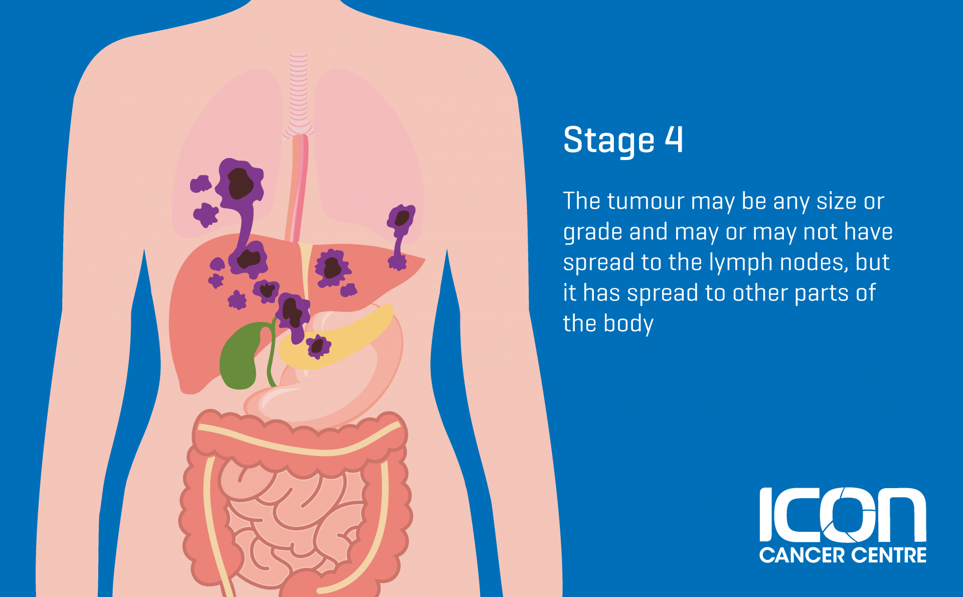 what-is-soft-tissue-sarcoma-soft-tissue-sarcoma-explained-icon