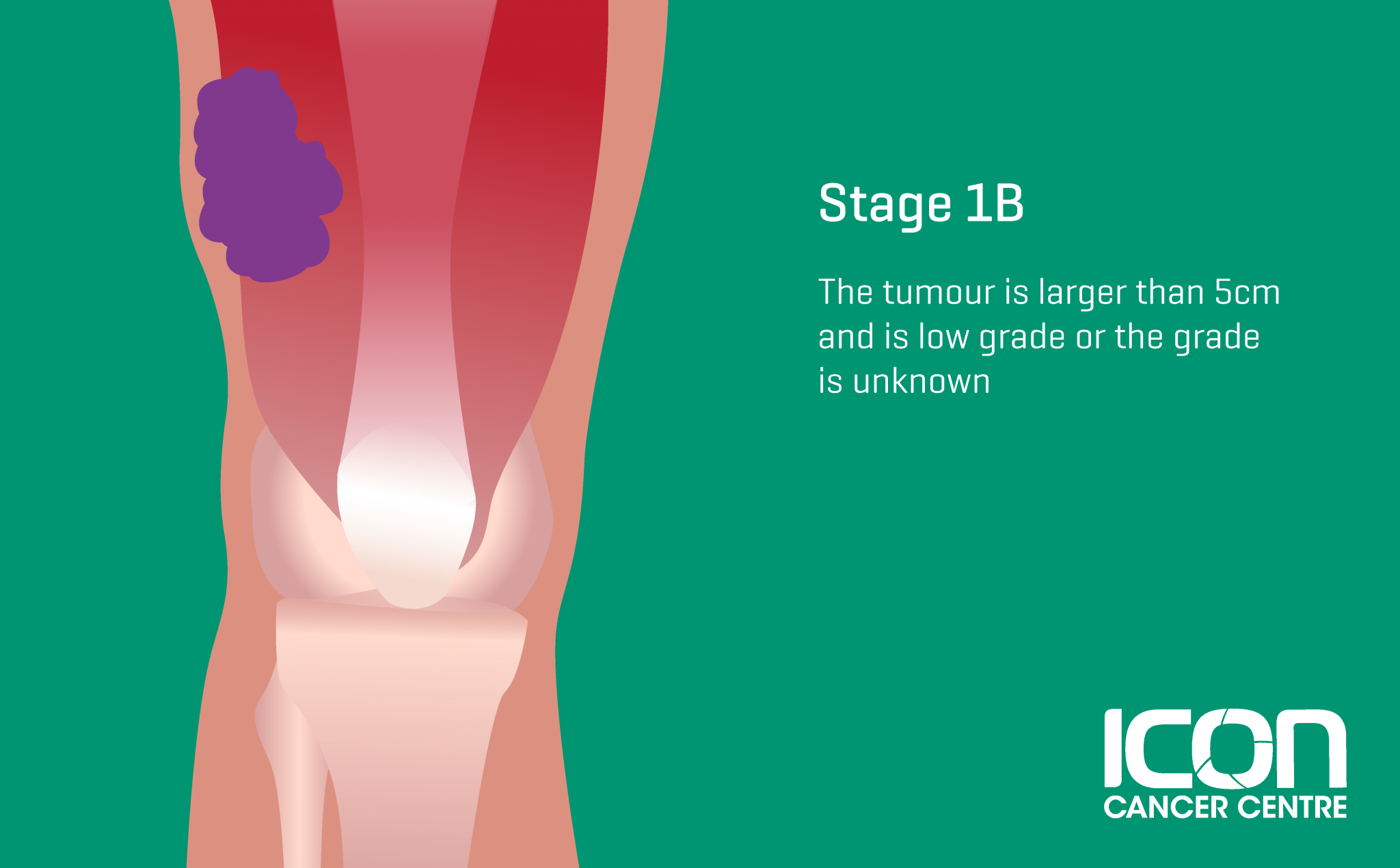 what-is-soft-tissue-sarcoma-soft-tissue-sarcoma-explained-icon