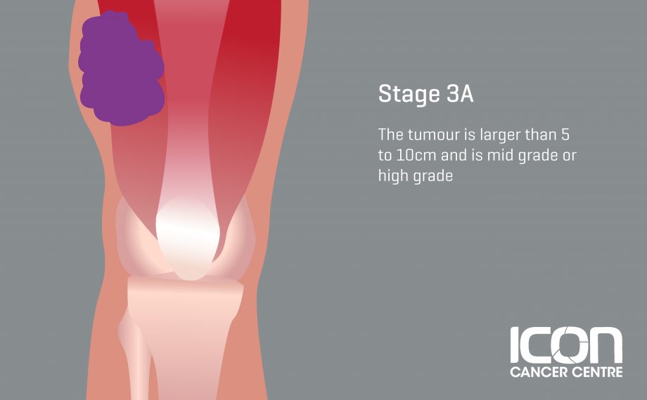 What Is Soft Tissue Sarcoma Soft Tissue Sarcoma Explained — Icon Cancer Centre