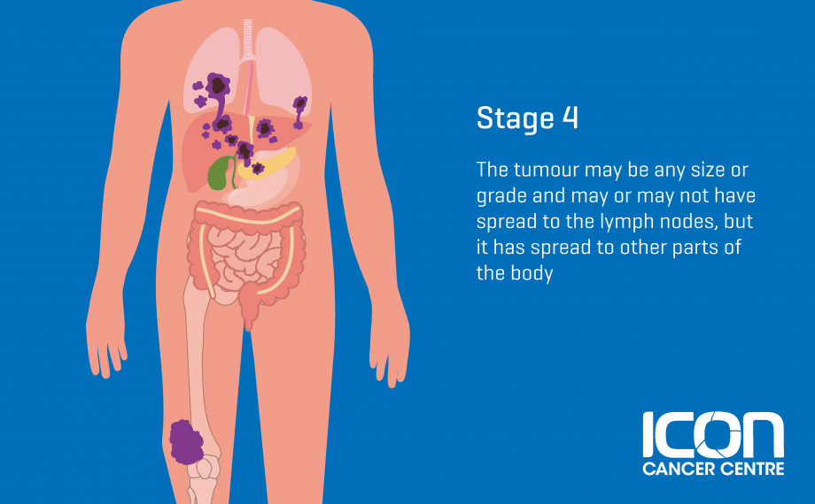 sarcoma cancer lymph nodes cancerul in stadiul 3 se vindeca