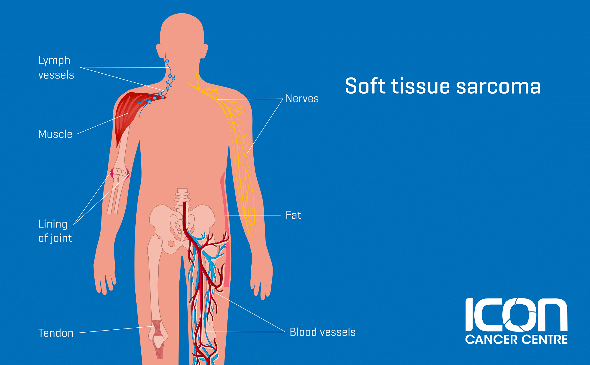 What Is Soft Tissue Sarcoma Soft Tissue Sarcoma Explained — Icon