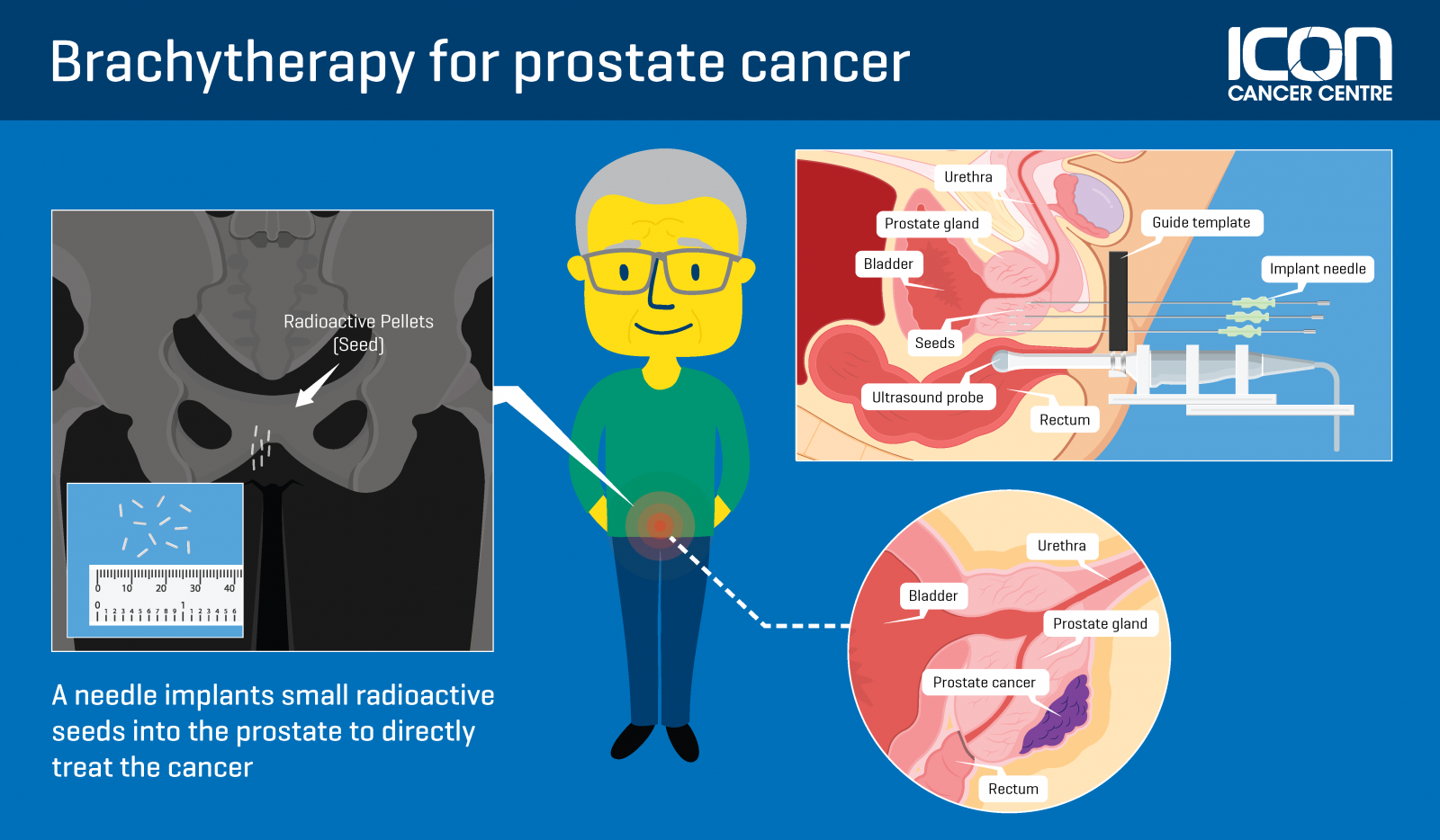 Focal Brachytherapy For Prostate Cancer — Icon Cancer Centre 3829