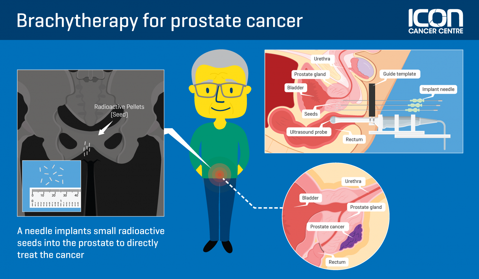 Focal Brachytherapy For Prostate Cancer Facebook 53 OFF