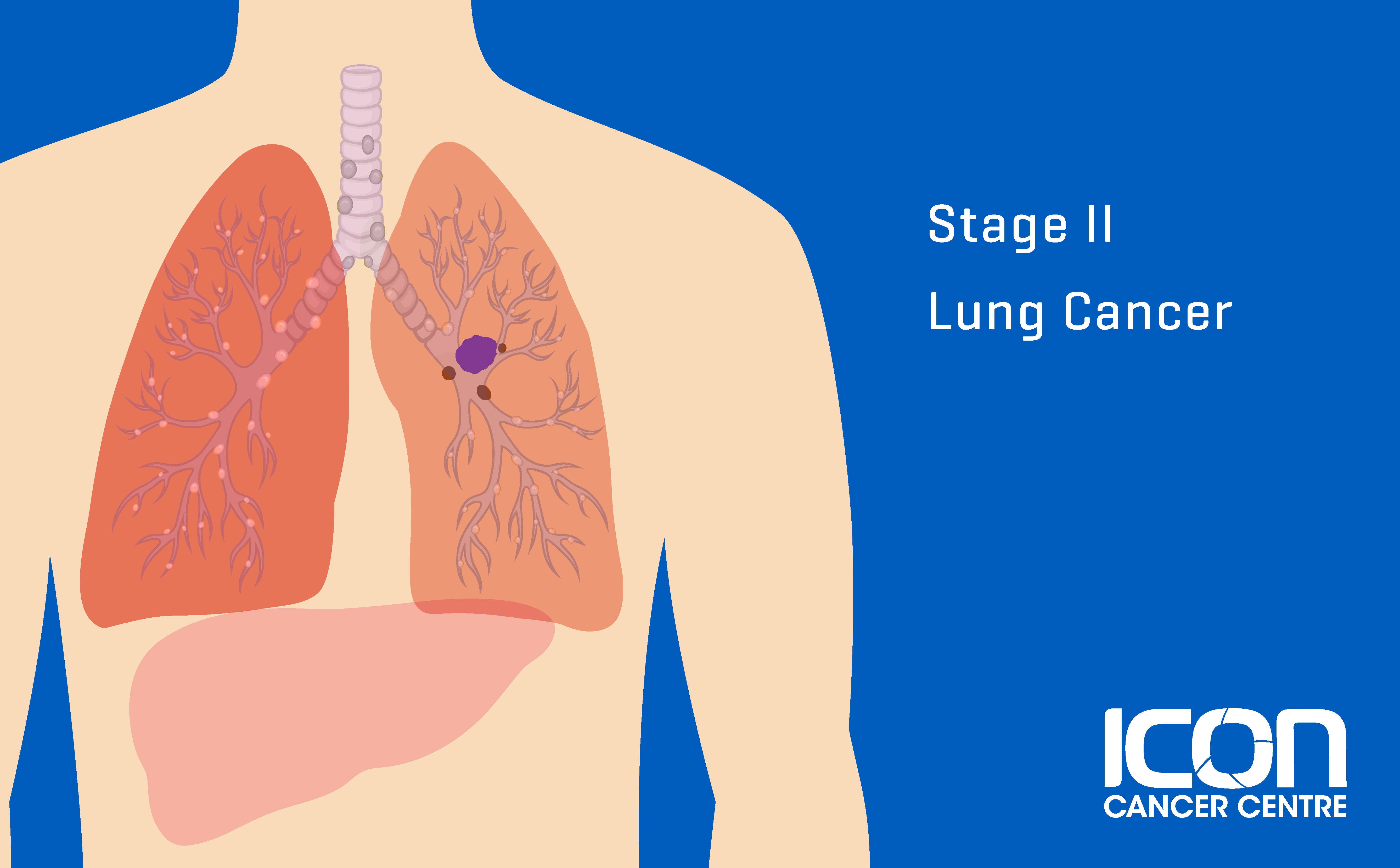 What is Lung Cancer? Lung Cancer Explained | Icon Cancer Centre