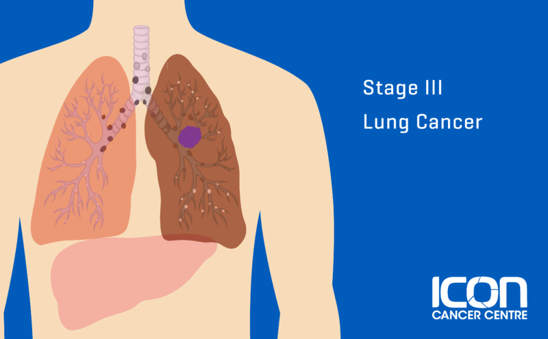 What is Lung Cancer? Lung Cancer Explained | Icon Cancer Centre