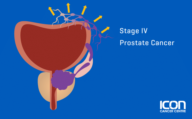 Stages Of Prostate Cancer