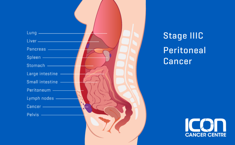 what-is-peritoneal-cancer-peritoneal-cancer-explained-icon-cancer-centre