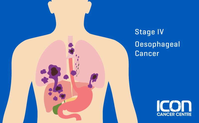 What is Oesophageal Cancer? Oesophageal Cancer Explained | Icon Cancer ...